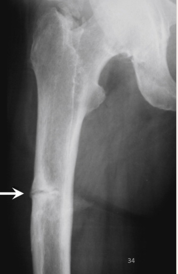 <p>What is this X-ray showing? What disease is it associated with?</p>