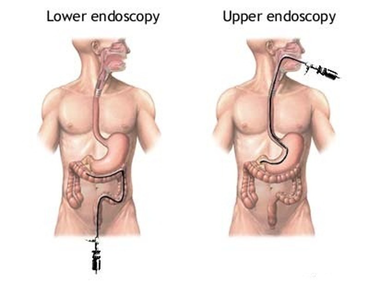 <p>-useful for dx of esophagitis or Barrett's</p><p>-not helpful in diagnosing GERD with no esophageal damage [use amb pH monitoring]</p>