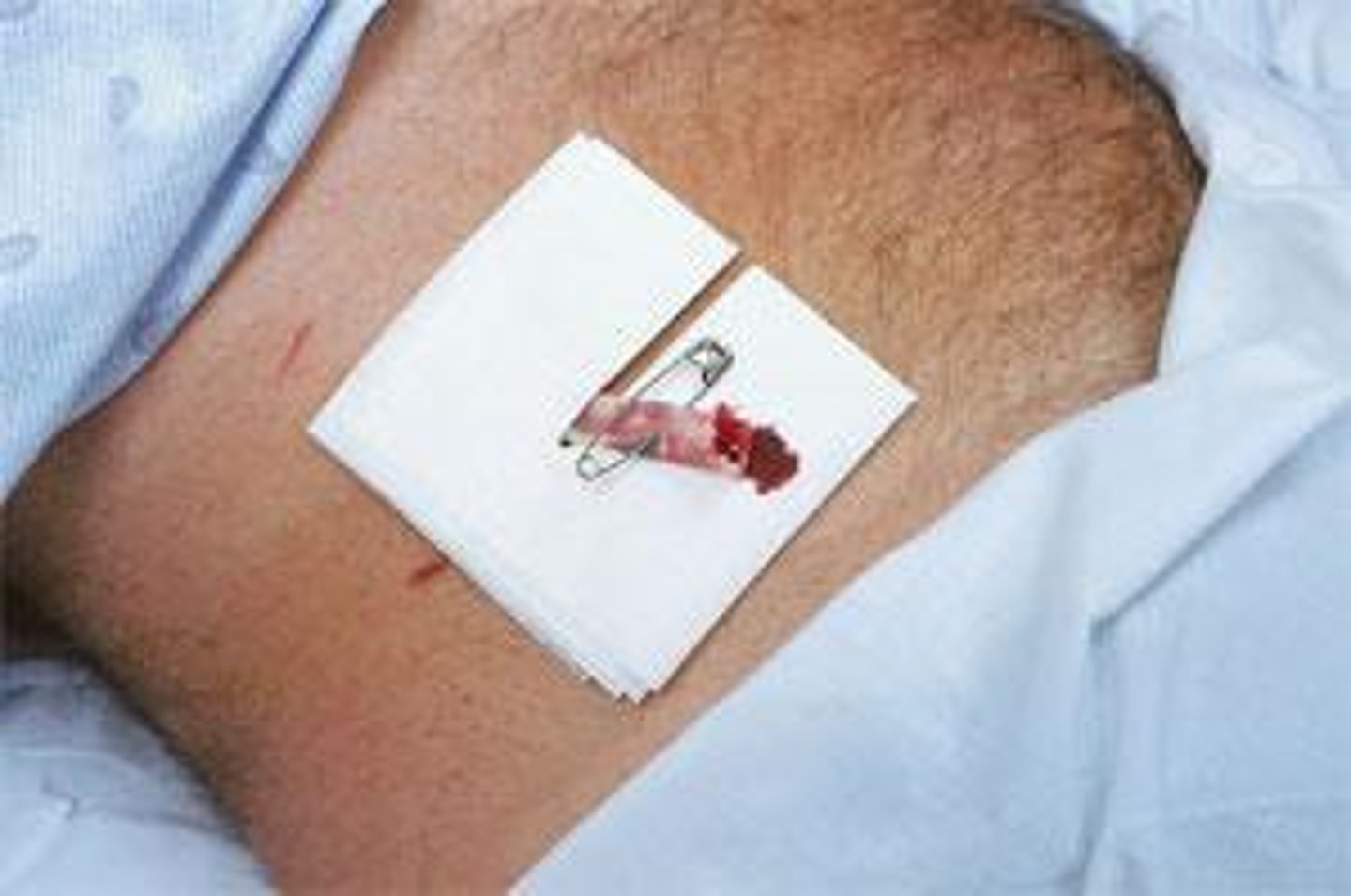 <p>-more prone to contamination<br>-Penrose drain</p>