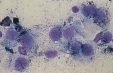<p>Can appear similar to other tumors (round cell, carcinoma, sarcoma)</p><p>~1/3 of cases are amelanotic (no pigment) </p>