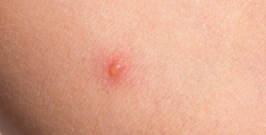 <p>A small, fluid filled sac or blister that is LESS than 1 cm</p>
