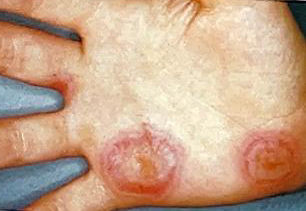 <ul><li><p>Identify the disease</p></li><li><p>Other name of the disease</p></li><li><p>Clinical feature</p></li><li><p>What is the associated syndrome</p></li></ul><p></p>