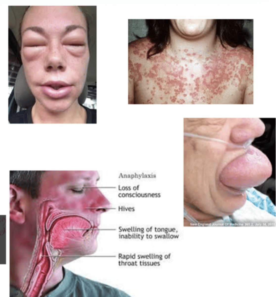 <p>A: Leukotrienes have the same effects as histamine but are 100× more potent</p>