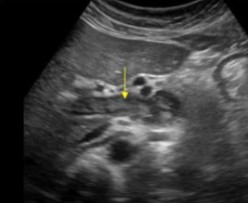 <ol><li><p>What structure is seen here?</p></li><li><p>What pathology is seen within it?</p></li></ol><p></p>