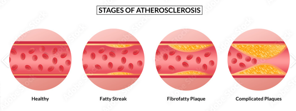 <p><strong>The pathologic condition of the heart refers to heart problems or diseases</strong></p><p><strong>1) Acute Coronary Syndrome (ACS):</strong> This is a term doctors use to describe a group of sudden and serious problems with the blood flow to the heart.</p><p>ACS includes:</p><ul><li><p><strong>Angina: </strong>Chest pain caused by temporary, reversible damage to heart tissue.</p></li><li><p><strong>Unstable angina:</strong> Chest pain that's more severe or happens more often and is a sign of a bigger problem.</p></li><li><p><strong>Myocardial infarction:</strong> This is a heart attack, where there is a permanent damage to heart tissue due to lack of blood flow.</p></li></ul><p>A heart attack may cause <strong>Extensive Tissue Necrosis</strong>, which is when a large area of tissue has died.</p><ul><li><p>This happens when the tissue doesn't get enough blood or oxygen, often due to injury, infection, or blocked blood flow.</p></li><li><p>Once tissue necrosis occurs, it cannot be reversed.</p></li></ul><p></p><p>The main reason ACS happens is <strong>atherosclerosis</strong>. </p><ul><li><p><strong>Atherosclerosis</strong> is the <strong>buildup of fats, cholesterol, and other substances in and on the artery walls</strong></p></li></ul><p></p>