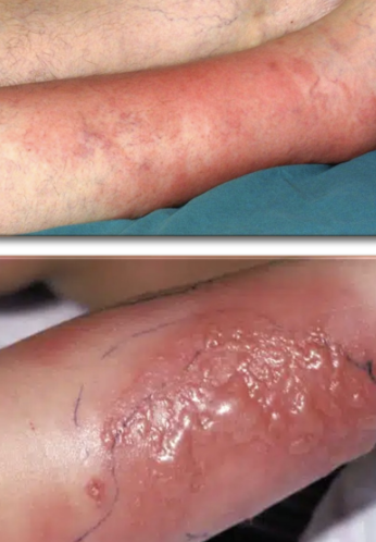 <p>MSSA, MRSA, GAS</p><p>§ Bacterial invasion extending into reticular dermis and subcutaneous fat</p><ul><li><p>Does not extend past subQ fat</p></li><li><p>Usually a good prognosis</p></li></ul><p>§ Risk factors (local to site)</p><ul><li><p>Skin trauma: Barrier disruption (abrasion, wound, ulcer, insect bite, IVDU)</p></li><li><p>Skin inflammation</p></li><li><p>Breaks in the skin between the toes</p></li><li><p>Preexisting skin infection: tinea pedis, impetigo, varicella</p></li></ul><p>§ Risk factors (person)</p><ul><li><p>Age</p></li><li><p>Edema (stretching of skin)</p></li><li><p>Obesity (stretching of skin)</p></li><li><p>Immunosuppression</p></li></ul><p>§ Clinical fx</p><ul><li><p>Warmth, erythema, pain, edema</p></li><li><p>Swelling can cause skin to break</p></li><li><p>Vitals usually OK</p></li><li><p>Borders ill-defined</p></li><li><p>Lower extremities most affected</p></li><li><p>Unilateral</p></li><li><p>Progresses slowly</p></li><li><p>Purulent or non-purulent, purulent suggests Staph</p></li><li><p>Abscesses can form: nodules are fluctuant</p></li><li><p>Vesicles, bullae (large fluid-filled cavities)</p></li></ul><p>§ Complications</p><ul><li><p>Bacteria can invade surrounding blood vessels </p></li><li><p>Bacteremia, endocarditis, osteomyelitis, metastatic infection, sepsis, toxic shock syndrome</p></li></ul><p></p>