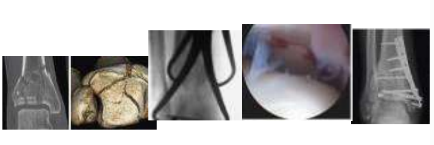 <ul><li><p>Schonung der Knochendurchblutung als Voraussetzung für rasche Knochenheilung</p></li><li><p>Erhalt des Muskelsgewebes, Vermeidung von Narbenbildung</p></li><li><p>Arthoskopie (mit Kamerasystemen innerhalb des Gelenks) → meist eine Kombination</p></li></ul><p>→Minimal-invasive Chirurgie</p><ul><li><p>Computernavigierte Chirgurgie</p></li></ul><p></p>