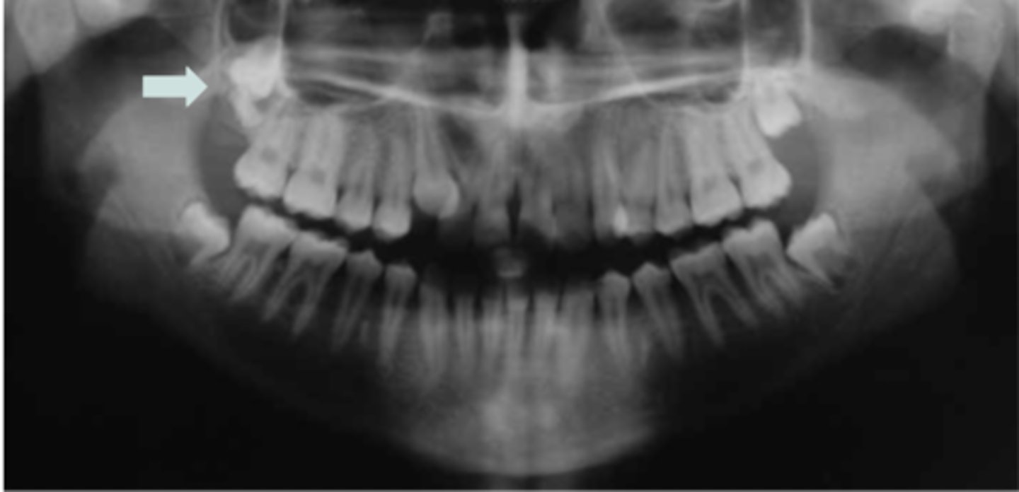 <p>4th molar</p>