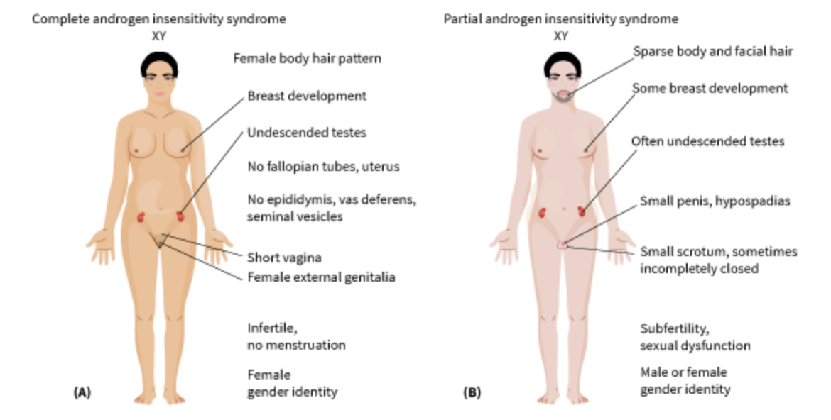 <p><span>1 in 13,000 XY fetuses; tissues in the XY fetus do not respond to testosterone. Child typically has a very shallow vaginal pouch, a clitoris, a non-cyclic hormone status, and testes that never descend. Detected when a seemingly typical adolescent female does not start menstruating at the standard age of puberty</span></p>
