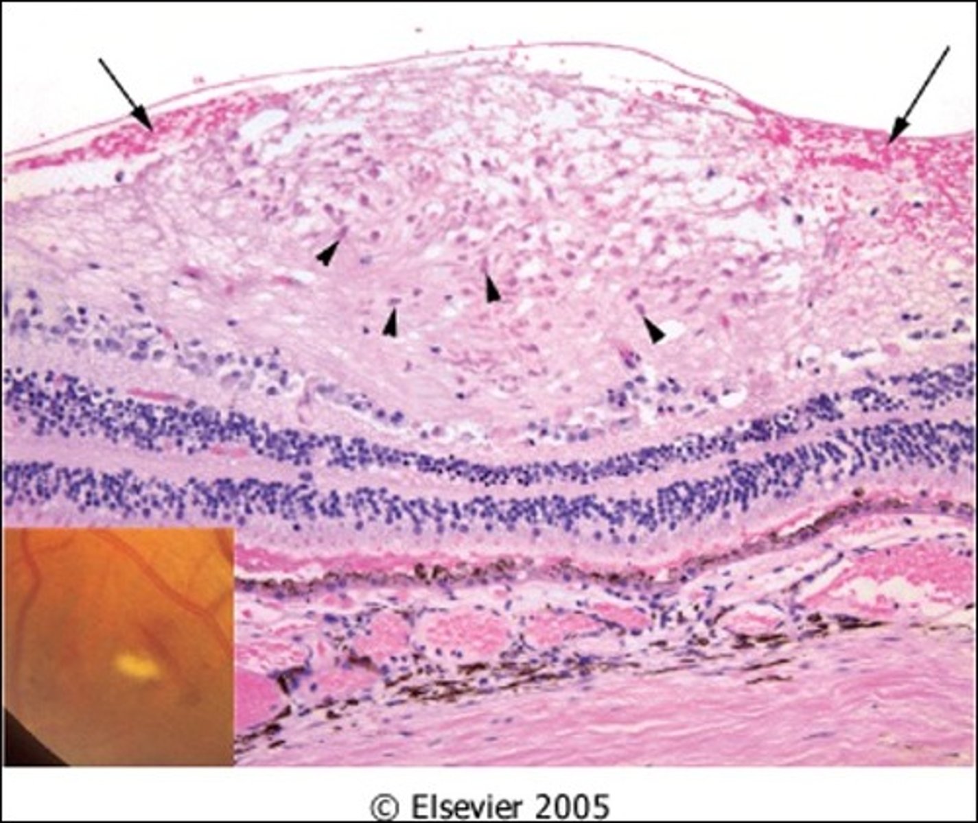 <p>Describe how Hypertension can negatively affect Retinal Function</p>