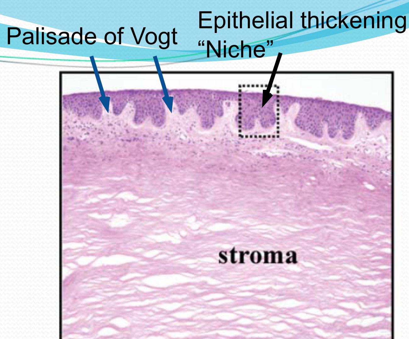 <p>epithelial thickenings in limbus</p>