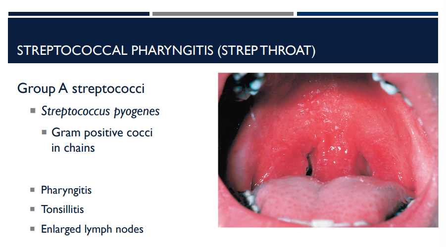<p>Steptococcal pharyngitis is also known as</p>