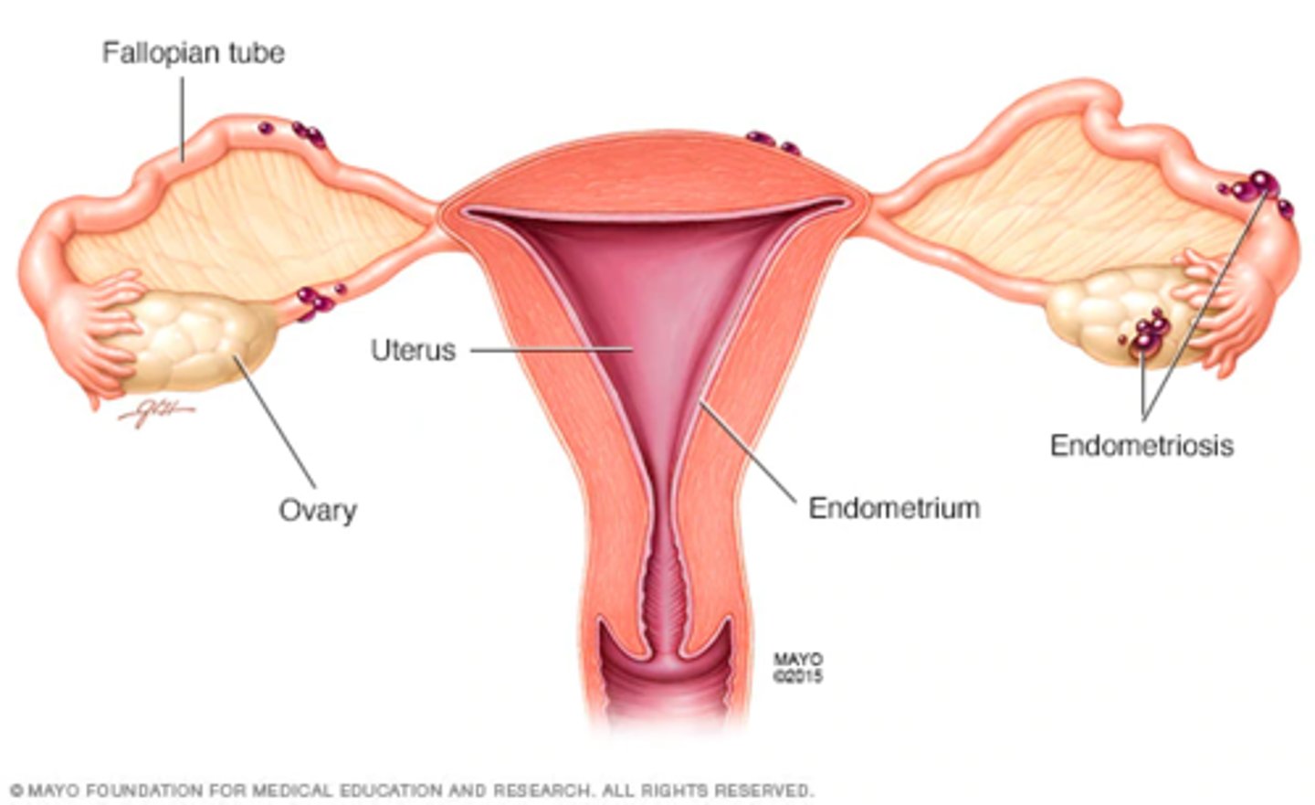 <p>-a condition in which tissue with a cellular structure and function resembling that of the endometrium is found outside the uterus</p><p>-atypical locations include ovaries, pelvic cavity, abdominal cavity</p>