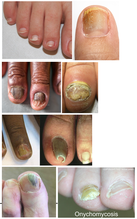 <p>What are <strong>common presentations</strong> of <strong>onychomycosis (tinea unguium)?</strong></p>