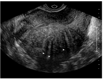 <p><strong>Uterine Adenomyosis: Evaluation</strong></p><p>-Pelvic exam → uterus is _______, diffusely __________, and soft </p><ul><li><p>“_______ globular enlargement” </p></li></ul><p>-Transvaginal ____________ is first-line imaging choice </p><p>-___ is used to distinguish between ______ and focal adenomyosis, focal adenomyosis and leiomyomas, and/or to help with treatment </p><p></p>
