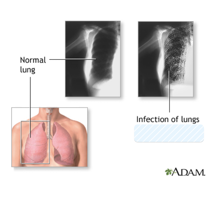 <p>Which fungus is transmitted <strong>airborne</strong> <strong>person-to-person</strong> and causes <strong><em><span>Pneumocystis </span></em><span>pneumonia</span><em><span> </span></em><span>(PCP)</span><em><span>? </span></em></strong></p><ul><li><p>almost 100% fatal if untreated</p></li><li><p>common disease in AIDS patients/immunocompromised</p></li></ul>
