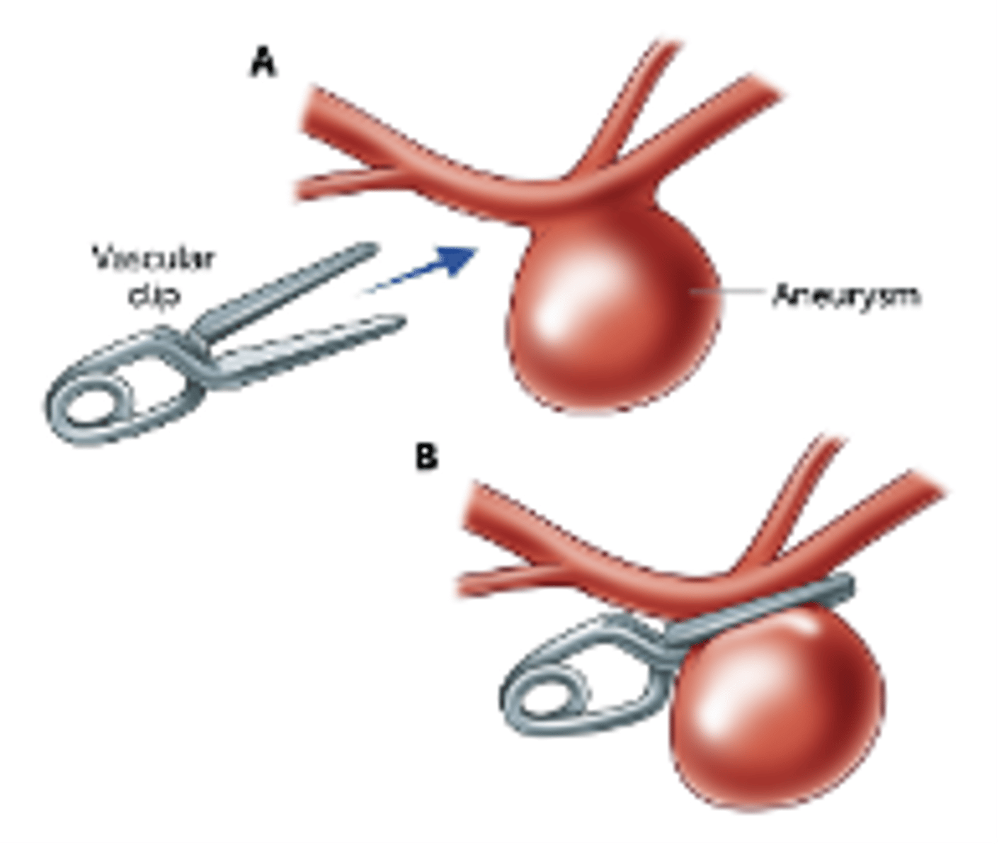 <p>Surgical Clipping</p><p>➢Physically place a clip on the aneurysm neck</p><p>➢Invasive requiring craniotomy</p><p>➢Best for wide neck aneurysms</p>