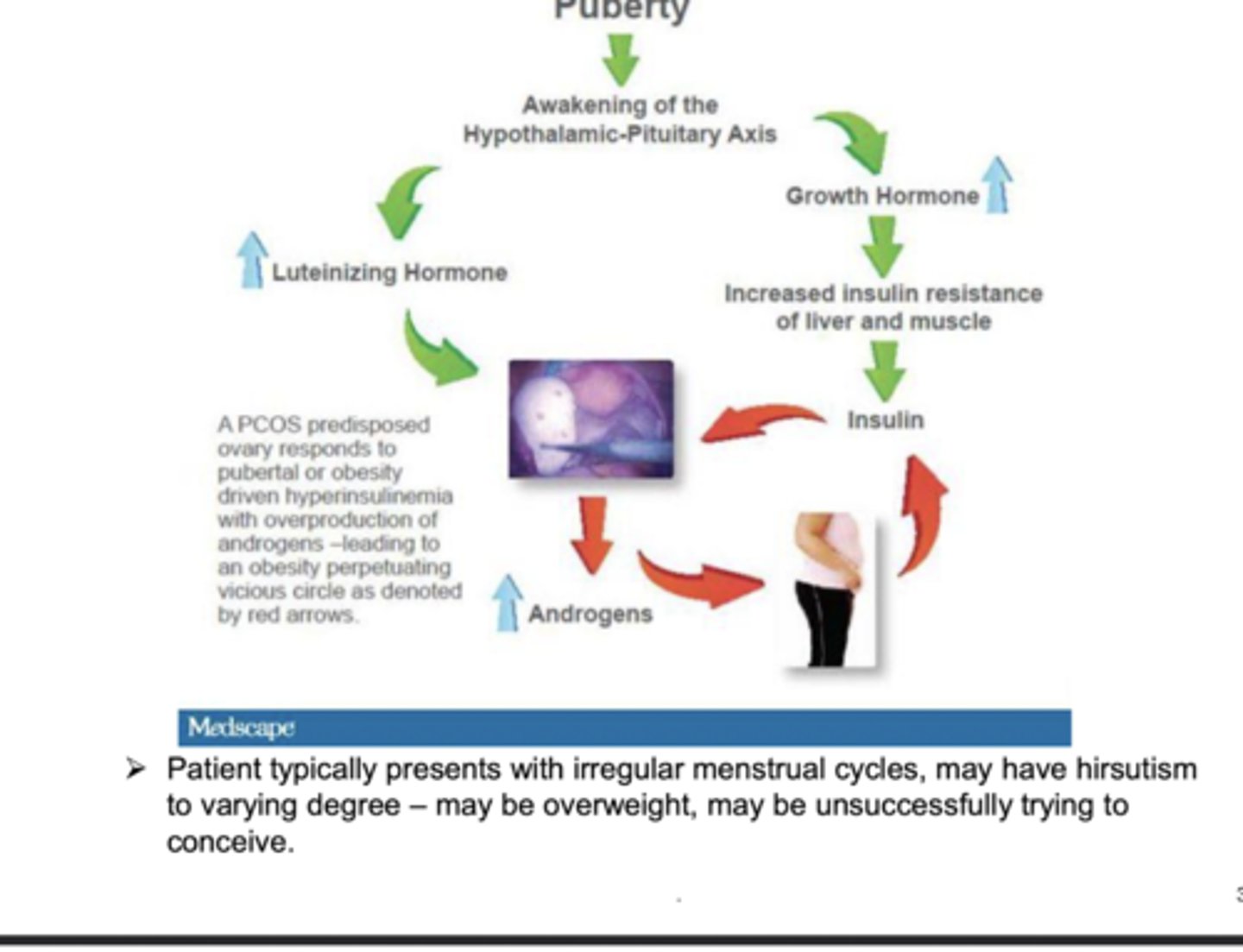 <p>spectrum of hormonal imbalance coupled with predisposition to insulin resistance. follicles develop but do not ovulate after LH surge. high LH levels continue and stimulates androgen production, which interferes with ovulation. ovaries contain many onovulated follicles called cysts</p>