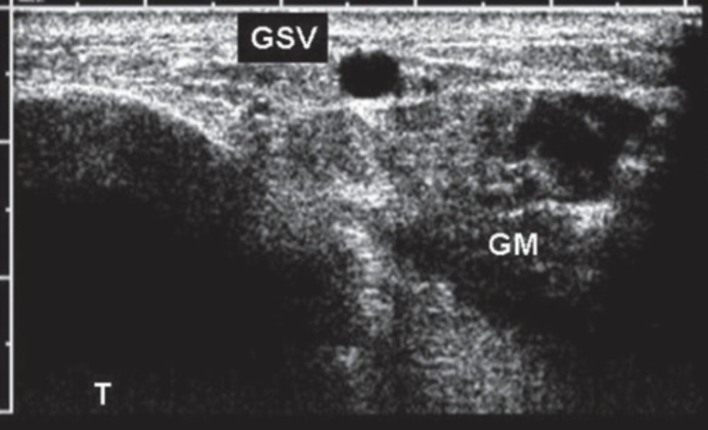 <p>Angle Sign</p><p>Triangular form between gastrocnemius muscle and tibial bone</p>