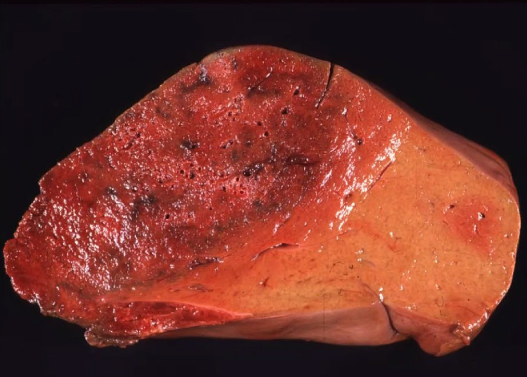 <p>What is the etiology?</p><p>A-Clostridium septicum</p><p>B-Clostridium haemolyticum </p><p>C-Clostridium chauvoei</p><p>D-Parac/ostridium sordellii</p>