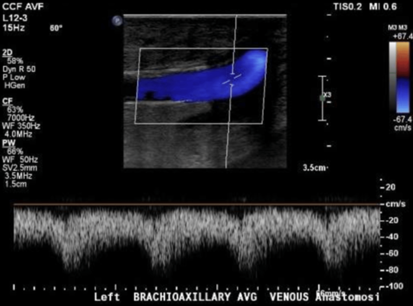 <p>Pulsatile flow</p>