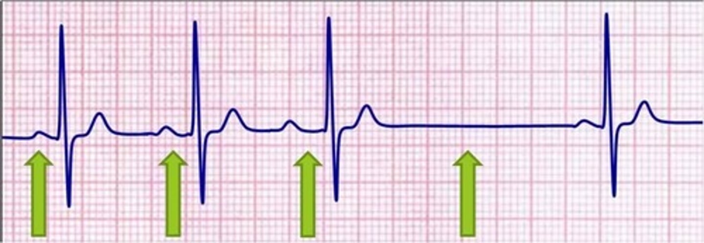 <p>Mobitz I Wenckebach block (longer, longer, drop now you've got a Wenckebach)</p>
