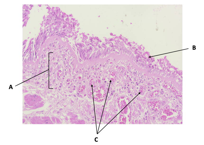 <p>Annotate the section of an asthmatic lung with reference to its appearance compared to a normal lung</p>