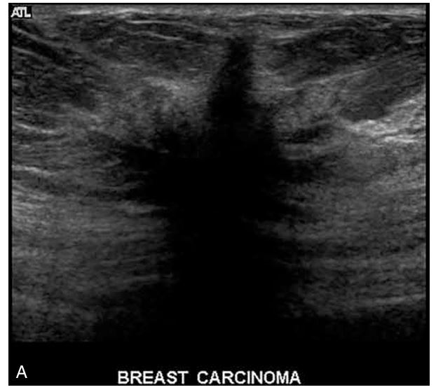 <ul><li><p>Malignant tumors are aggressive and tend to grow through tissue via finger-like extensions termed _______</p></li><li><p>they are highly suspicious for malignancy</p></li><li><p>appear as small lines that radiate outward from the surface of a mass </p></li><li><p>typically alternating hypoechoic and hyperechoic lines.</p></li></ul><p></p>