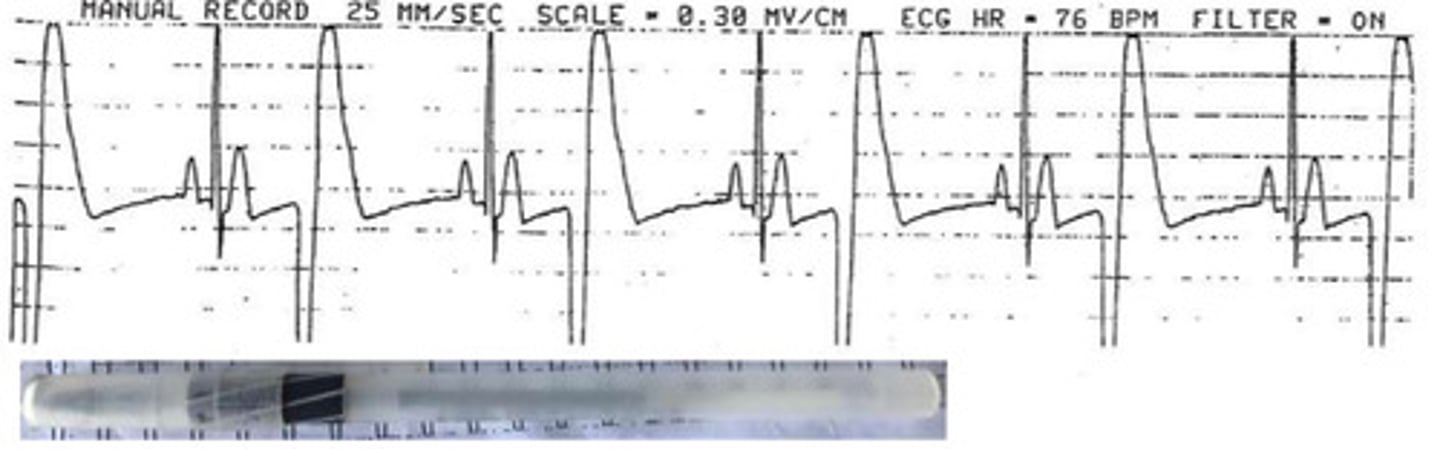 <p>How do you know that this isn't a ventricular issue?</p>