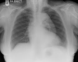 <p><strong>Thoracic Aortic Aneurysm: General Info</strong></p><p>-Primary etiology = _____________</p><p>-Most are ____________, but some patients do present with varying symptoms</p><ul><li><p>neck/back pain, dyspnea, dysphagia, hoarseness, or brassy _______</p></li></ul><p>-Physical exam = stridor, ______ in neck/arms, distended neck veins</p><p>-Findings = ________ mediastinum on CXR</p>