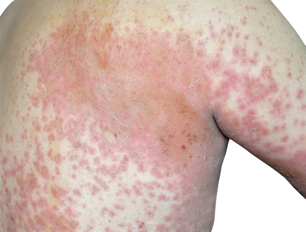 <p>pt w/ 1 month diarrhea, abd cramps, nausea, night sweats, nontender lympadenopathy, arthralgias, weight loss. pink, oval lesions (see pic) on upper chest, neck, face at the <strong>beginning of illness</strong> but have resolved.</p>