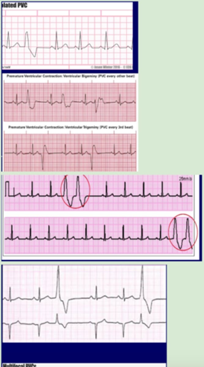 <p>Originate: irritable ventricular focus</p><p>QRS complex: wide</p><p>P wave: same until PVC</p><p>Heart rate: 60-100 bpm until PVC</p><p>R-R intervals: regular until PVC</p><p>Regularity:</p><p>-Isolated</p><p>-Bigeminy (every other beat)</p><p>-Trigeminy (every 3rd beat)</p><p>Series:</p><p>-Couplet (2 in row)</p><p>-Triplet (3 in row)</p><p>Morphology:</p><p>-Unifocal (same morphology)</p><p>-Multifocal (different morphology)</p>