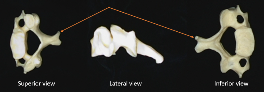 bifid spinous process 