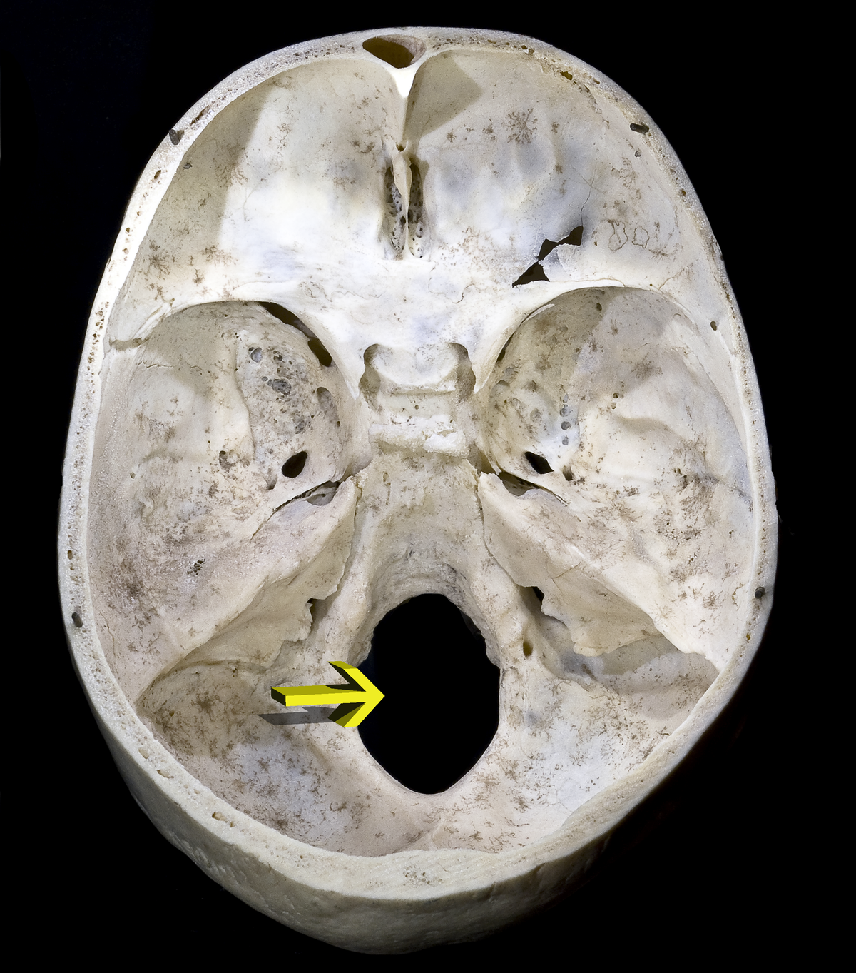 <p>Hole through bone</p><p>ex: Foramen magnum</p>