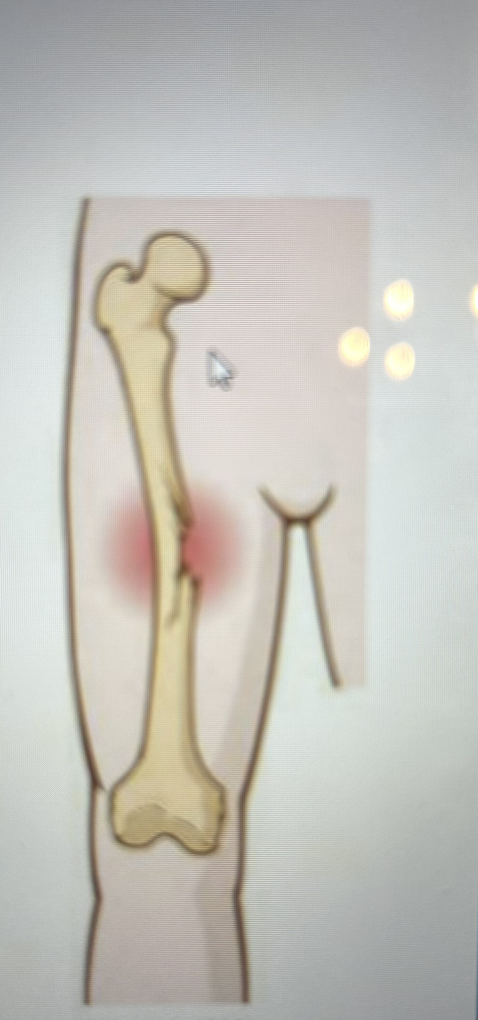 <p>What type of fracture is this?</p>