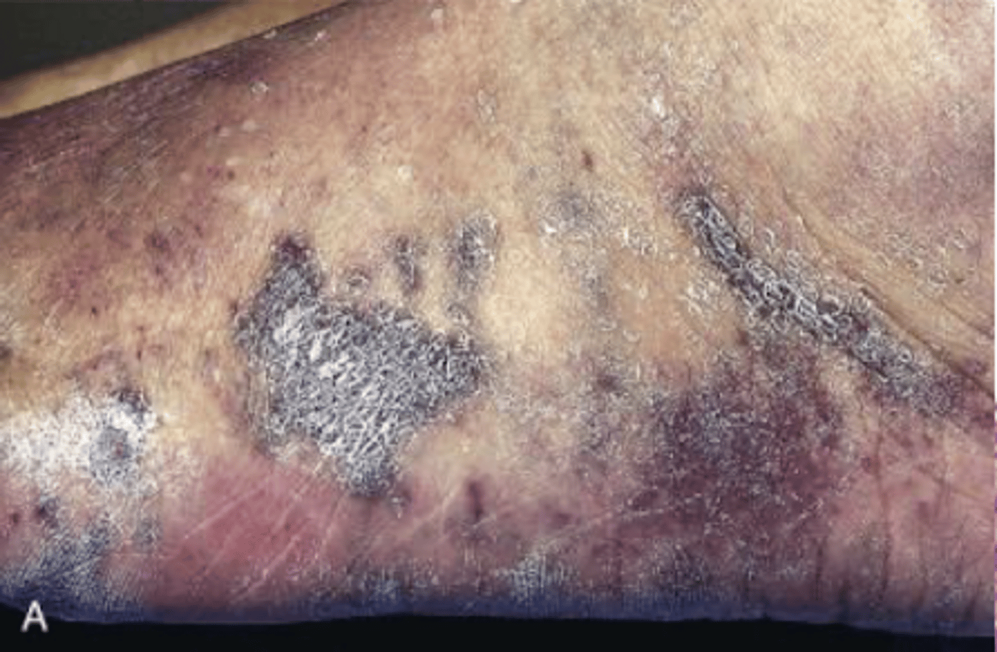 <p>3 stages of cutaneous lesions in LE</p><p>1. patches</p><p>2. raised plaques</p><p>3. nodular</p>