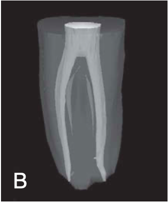 <p><span>(symmetrical type)</span></p><p><span>separated mesial and distal canals in each root, which exit as separate canals</span></p>