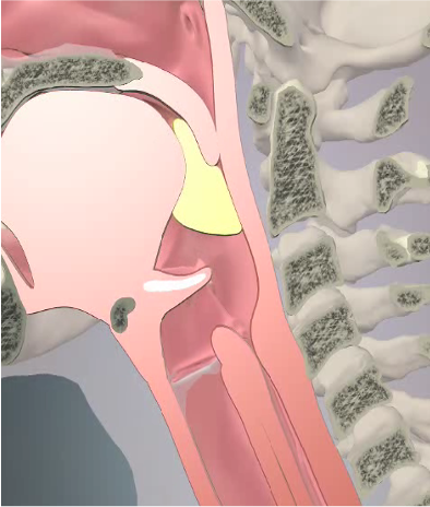 <p>Involuntary and Voluntary </p><p>Involuntary: Once initiated, it cannot be reversed </p><p>Voluntary: Complex and sequential control of muscles to protect airway from bolus </p><p>Initiated about the time when the bolus head is passing any point between the anterior faucial pillars and the ramus of the mandible </p><p>The bolus passes from the pharynx into the esophagus, taking less than one second </p><p>Respiration ceases reflexively at this point </p><p>Velum is elevated </p><p>Tongue is retracted </p><p>Lips are sealed </p><p>A tight seal is formed to protect the airway </p><p>The bolus passes over epiglottis through the pyriform sinuses to the esophagus </p><p></p>