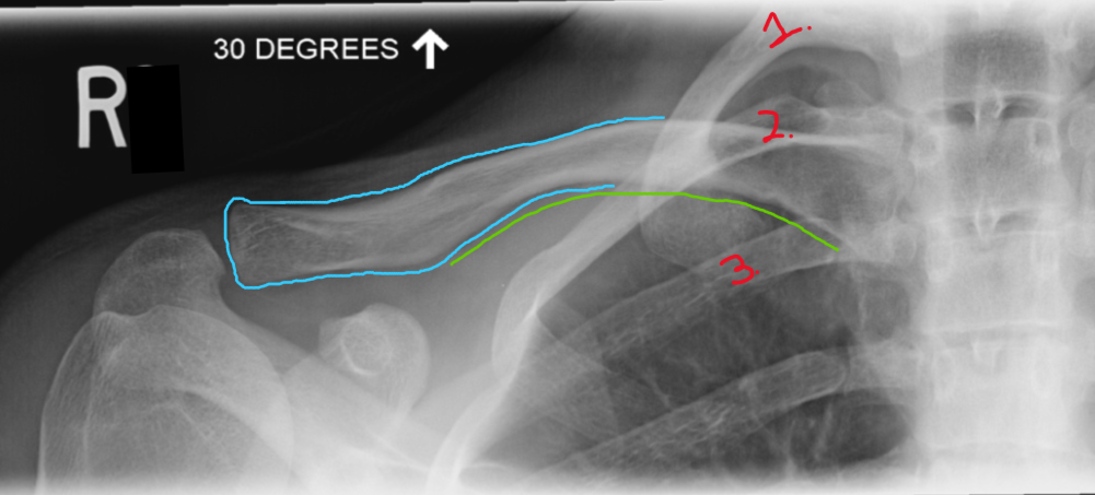<ul><li><p>medial end of clav SI 1st, 2nd, or 3rd ribs</p></li><li><p>LAT 2/3 of clav projected superior to thorax and scapula</p></li><li><p>clav bow upward slightly </p></li></ul><p></p>