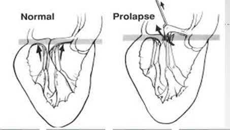 <p>mitral valve prolapse</p><p>degenerative / myzomatous mitral valve disease </p>