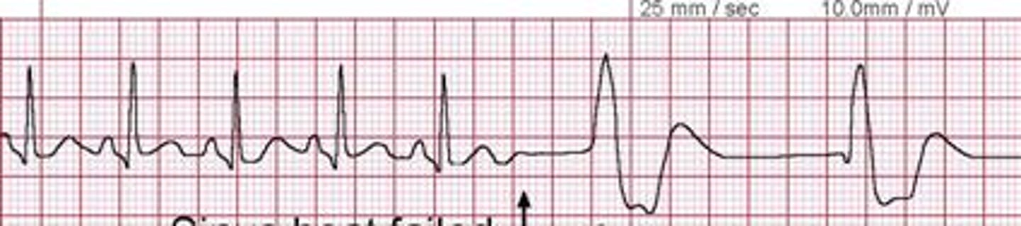 <p>Which Arrythmia is this?</p>