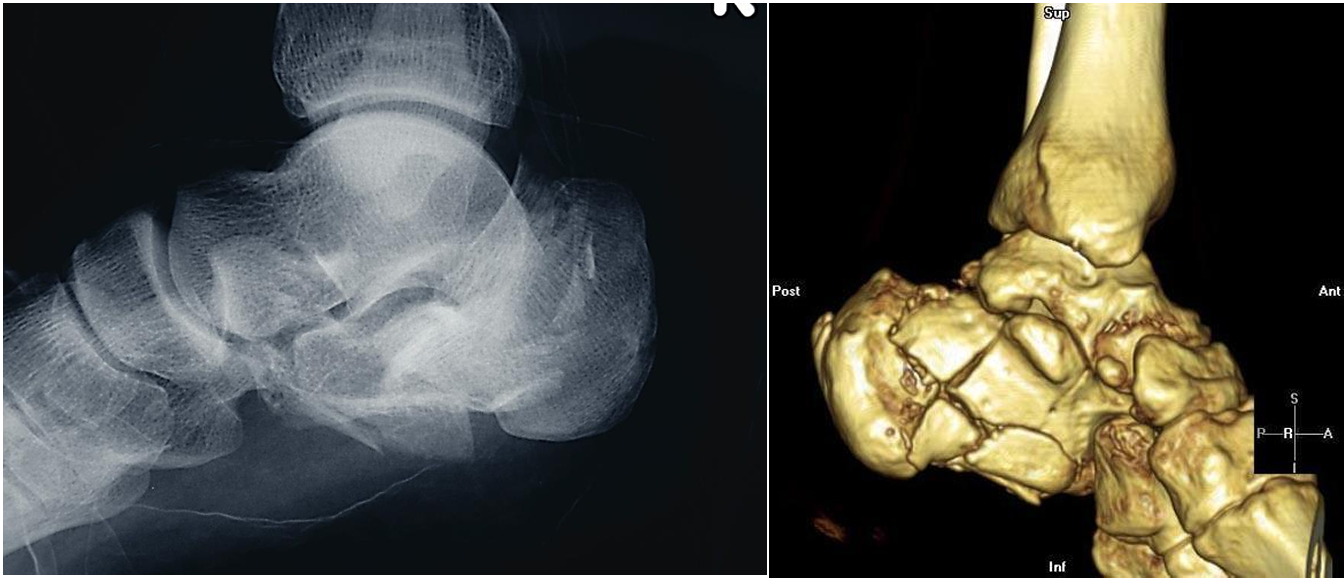 <p>Patient history: a history of a fall from a height </p><p> Modality: ankle X-ray – lateral view (left image), CT 3D reconstruction (right image) </p><p>Region: left ankle </p><p>Radiologic sign: abrupt discontinuity of the cortex of the calcaneus, lucent fracture lines </p><p>Diagnosis: comminuted fracture of the calcaneus (Lover’s fracture or Don Juan-fracture)</p>