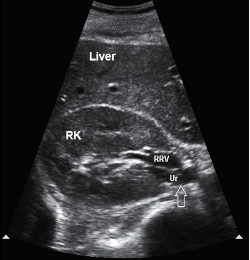 <p>Normal TRV kidney </p>