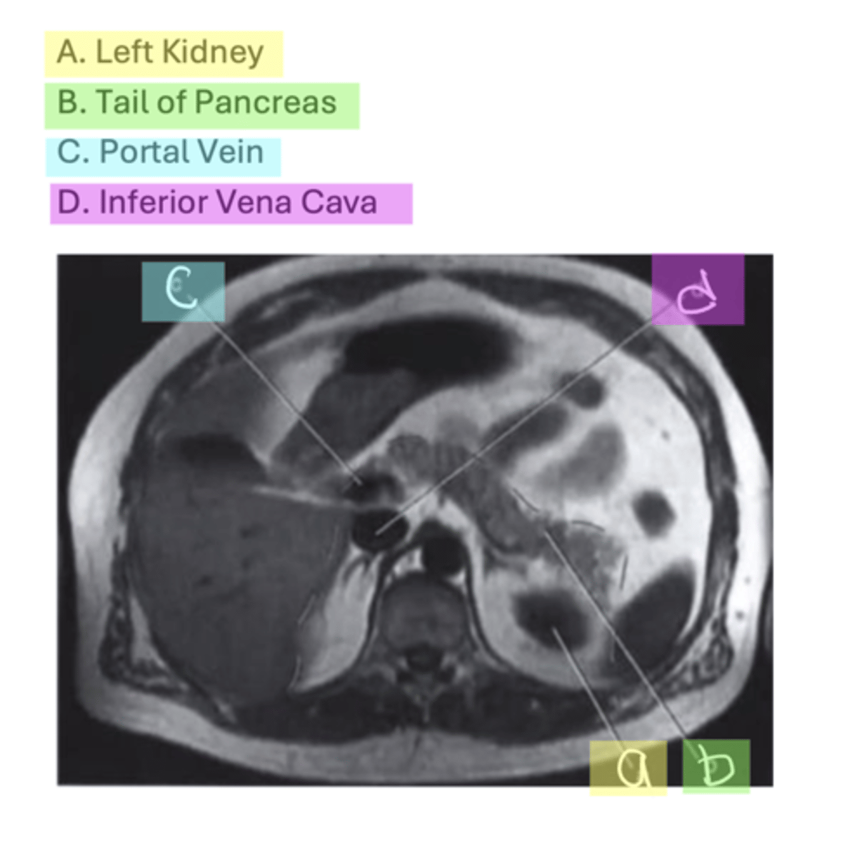 <p>A. Left Kidney</p><p>B. Tail of Pancreas</p><p>C. Portal Vein</p><p>D. Inferior Vena Cava</p>