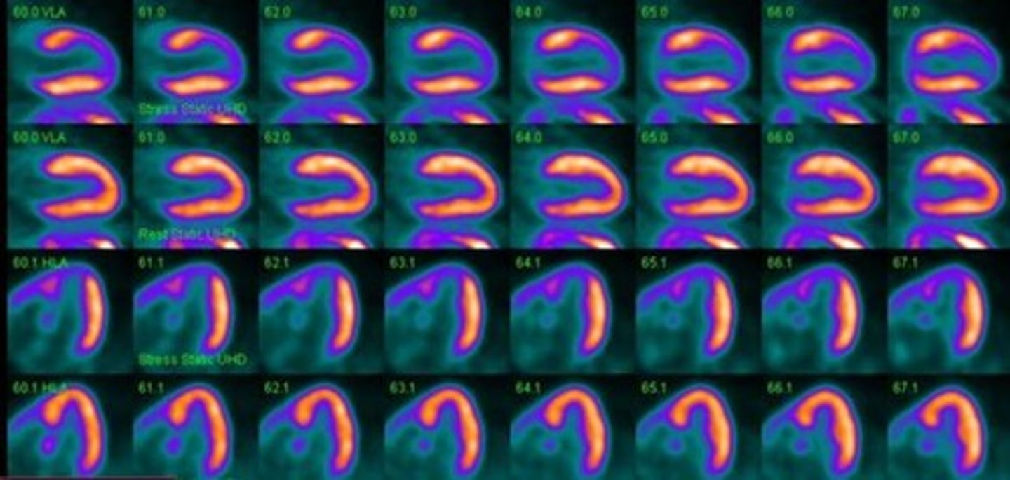 <p>To show the distribution of blood flow (perfusion) in the myocardium of the left ventricle.</p>