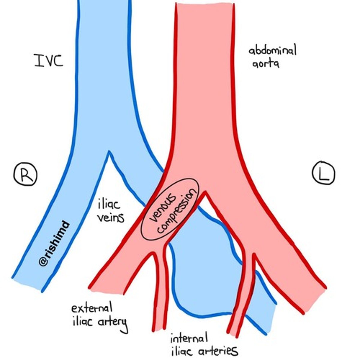 <p>Narrowing of the left iliac vein due to compression by the right iliac artery, increasing risk for lower extremity DVT.</p>