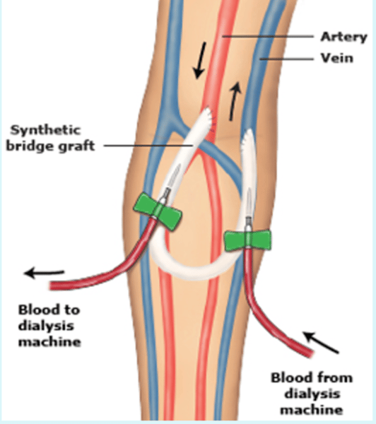 <p>artificial connections of veins<br>- if fistula is working properly during hemodialysis, you should be able to feel a "thrill"<br>- auscultate to hear the "bruit"</p>