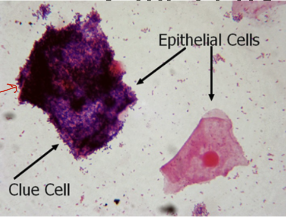 <ul><li><p>Many labs use Gram stain to evaluate the presence or absence of bacterial vaginosis</p></li><li><p>In these smears, vaginal epithelial “clue cells” will be covered with bacterial morphotypes. Sheer number of organism cover the margin of epithelial cells</p></li></ul><p></p>