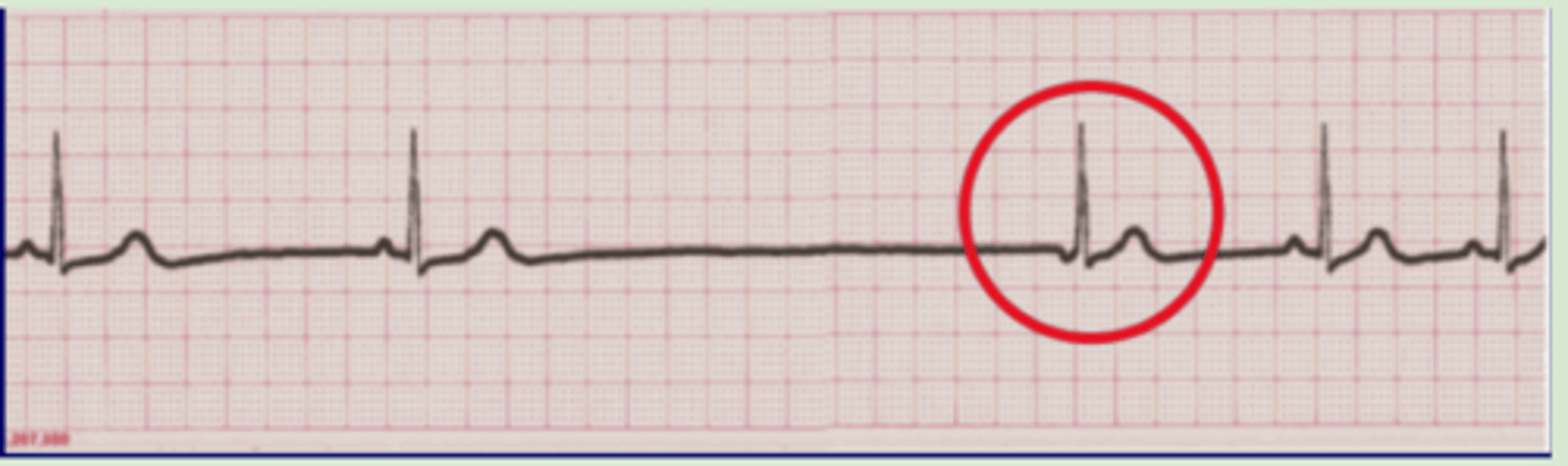 <p>Regular sinus rhythm with a long pause followed by a singular junctional beat and return to normal sinus</p>