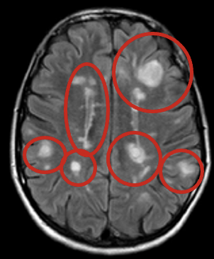 <ul><li><p><span>Based on clinical findings, imaging &amp; lab findings</span></p></li><li><p><span style="color: yellow"><strong>Neuropsychological testing</strong></span><span>—test for cognitive impairment</span></p></li><li><p><span style="color: yellow"><strong>MRI</strong></span><span>: plaques in CNS distributed in different areas</span></p></li><li><p><span style="color: yellow"><strong>LP/CSF analysis</strong></span><span>: presence of oligoclonal binding</span></p></li><li><p><span style="color: yellow"><strong>Evoked potential studies</strong></span><span>—measure electrical activity in parts of CNS in response to stimuli</span></p></li><li><p><span style="color: yellow"><strong>Urodynamics</strong></span><span>—– to diagnose underlying bladder dysfunction</span></p></li></ul><p></p>